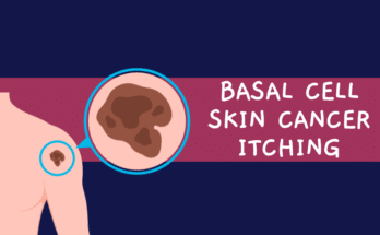 Basal Cell Skin Cancer Itching