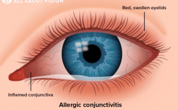 Can a Sinus Infection Cause Pink Eye?