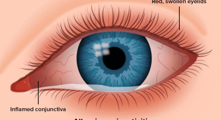 Can a Sinus Infection Cause Pink Eye?