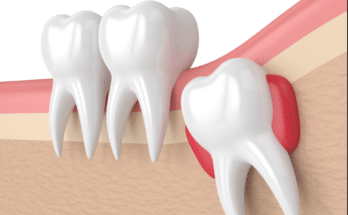 extract a tooth that is infected