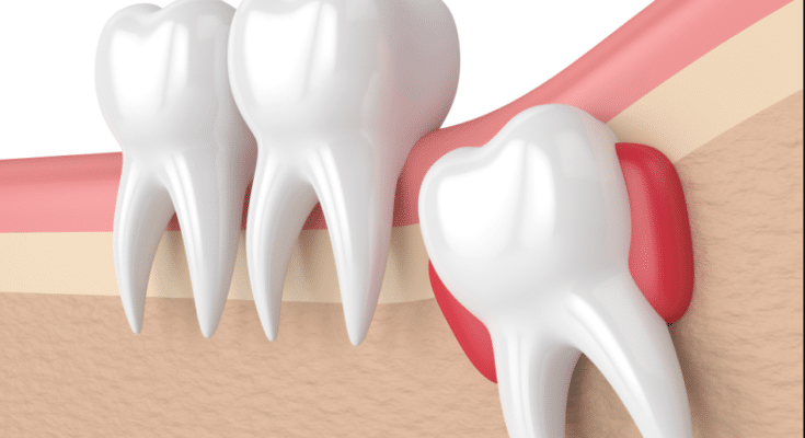 extract a tooth that is infected